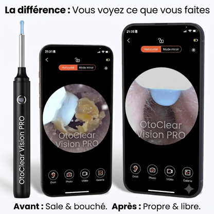 OtoClear Vision — Nettoyeur auditif intelligent 360°
